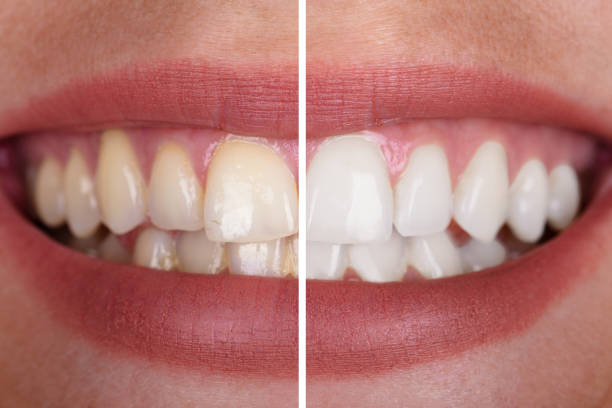 ✨BLANQUEADOR DENTAL DENTAL WHITE 20 MIN