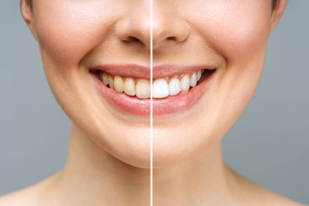 ✨BLANQUEADOR DENTAL DENTAL WHITE 20 MIN